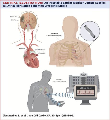 Telemetry Monitoring Lead Placement