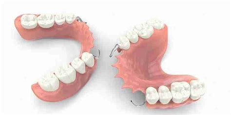 Removable Partial Dentures Everything You Need To Know