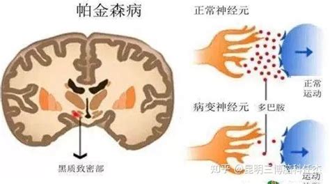 帕金森患者如何用药最有效？正确服用要牢记这5大点原则！ 知乎