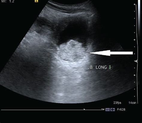 Ultrasonography Showing Hyperechogenic Contents In The Urinary Bladder Download Scientific