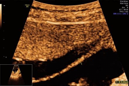 Prenatal Diagnosis And Management Of Fetal Discordant Alpha