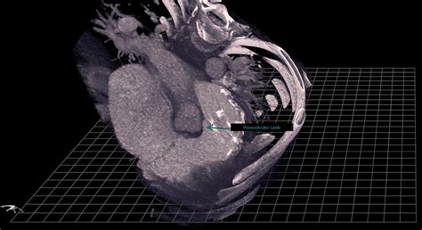 Computed Tomography Viewed On True3D Viewer Echopixel Inc Mountain