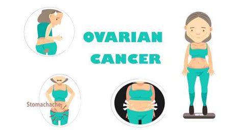 7 Symptoms Of Ovarian Cancer You Should Be Aware Of