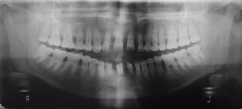 Orthopantomograph Showed Severe Horizontal Alveolar Bone Loss