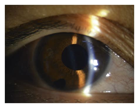 A Slit Lamp Examination Showing A Shallow Anterior Chamber And Light Download Scientific