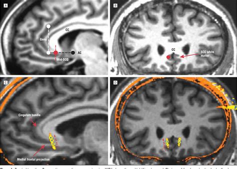 Posterior Cingulate Cortex | Semantic Scholar