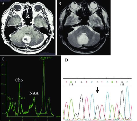 A T1 Weighted Magnetic Resonance MR Imaging With Gd DTPA Revealed A