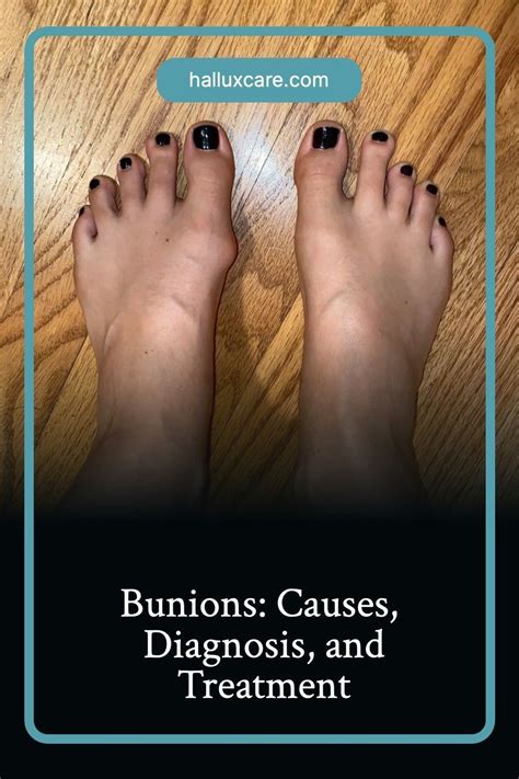 Bunion Treatments The Best Ways To Treat Bunions Artofit