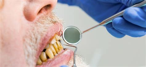 Doen A Periodontal Uma Das Principais Causas De Perda Total De Dentes