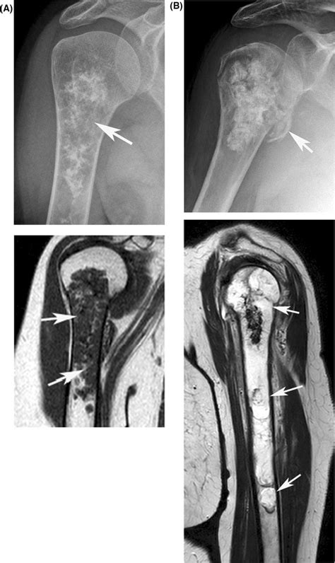 Images Of Typical Chondral Tumours A Grade Chondrosarcoma I