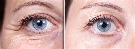 NewLife Aesthetics Clinic Global Eyecon Treatment Raynes Park