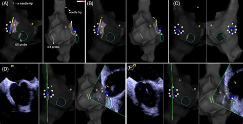 Zerofluoroscopy Transseptal Puncture Guided By Right Atrial