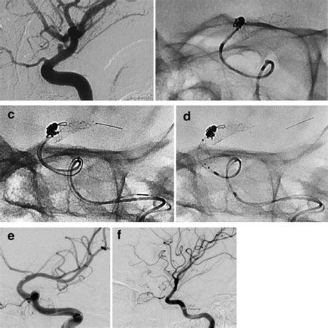 Illustrative case 2. A 50-year-old woman developed a sudden headache ...