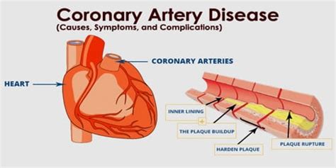 Coronary Artery Disease (Causes, Symptoms, and Complications ...