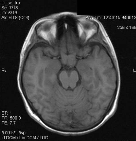 Optic Chiasm Mri Anatomy