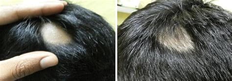 Minoxidil Before And After Photos And Results Wimpole Clinic