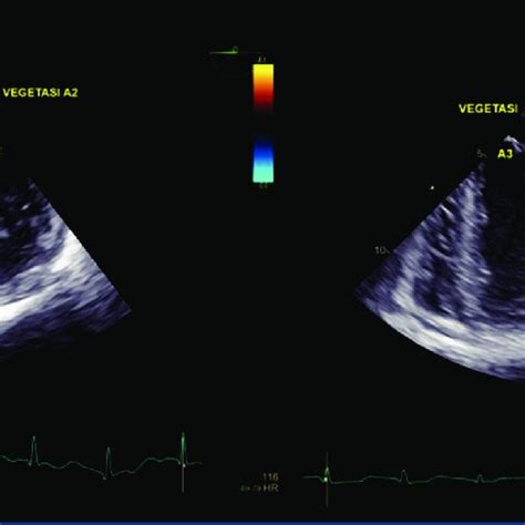 A Electrocardiography Showed Sinus Tachycardia Bpm And Normoaxis