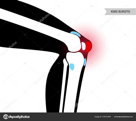 Concepto de inflamación de bursitis vector gráfico vectorial Pikovit