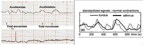 Fetal Heart Rate Fhr And Uterine Contraction Data Stored In The Data Download Scientific