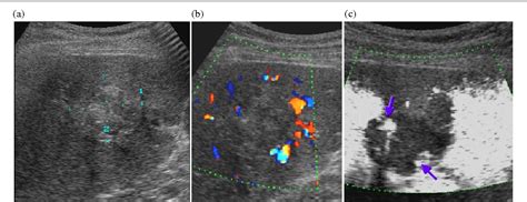 Figure 2 From Role Of Contrast Enhanced Color Doppler Ultrasonography