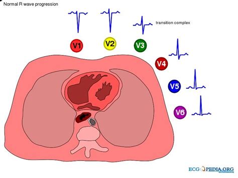 Normal R Wave Progression R Wave Progression Is The Phenomenon Where