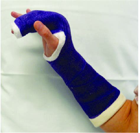 Ulnar Gutter Splint