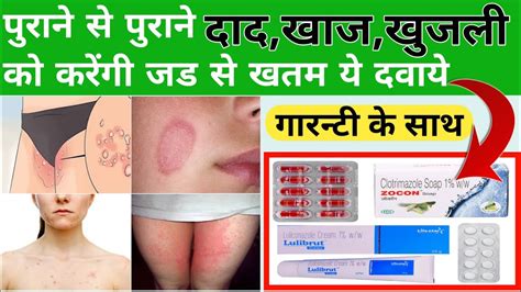 दद खज खजल क जड स खतम कस कर Best medicine for allergy Daad