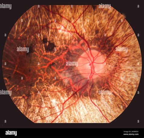 Trastorno De La Retina Fotografías E Imágenes De Alta Resolución Alamy