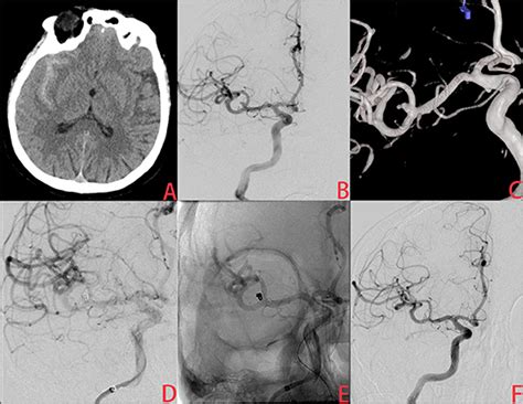 Frontiers Endovascular Treatment Of Ruptured Very Small Intracranial