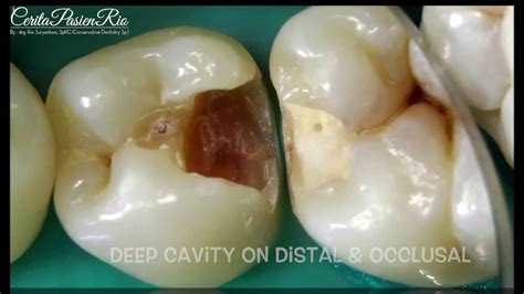 Class Ii Restoration With Different Approach Tambalan Resin Komposit