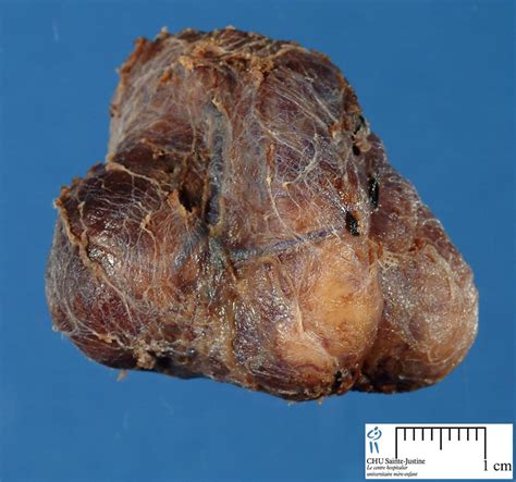 Thyroid Nodular Hyperplasia Humpath Human Pathology Photos