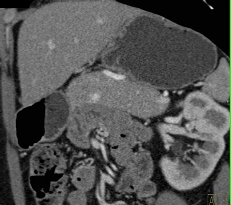 Incidental 1cm Neuroendocrine Tumor In Body Of The Pancreas Pancreas