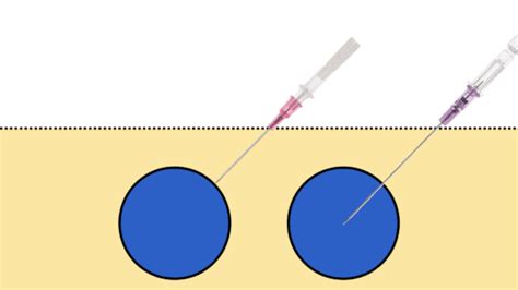 Peripheral Pressors Ultralong Catheter Rebel Em Emergency