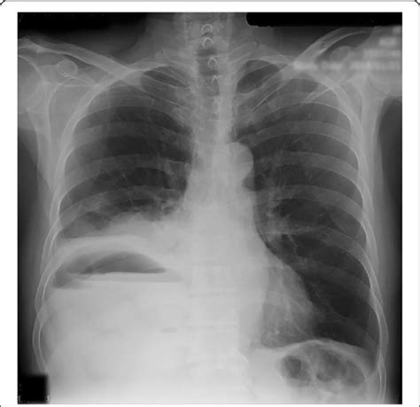 Enlarged Liver X Ray