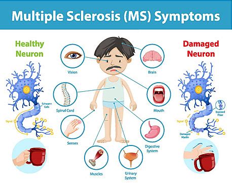 Multiple Sclerosis Ms Symptoms Information Infographic System Face ...