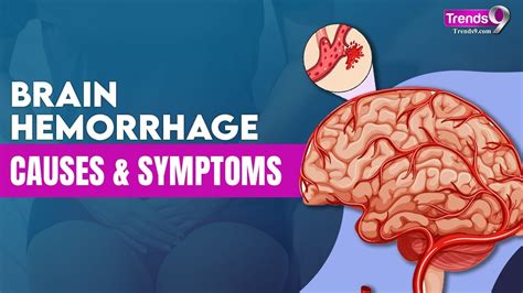 Understanding Brain Hemorrhage Symptoms And Causes Brainhemorrhage