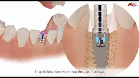 Temporary Snap Abutment Simplify Your Temporization Workflow YouTube