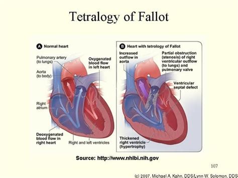 Tetralogy Of Fallot Tetralogy Of Fallot Atrial Septal Defect Congenital Heart Heart Defect