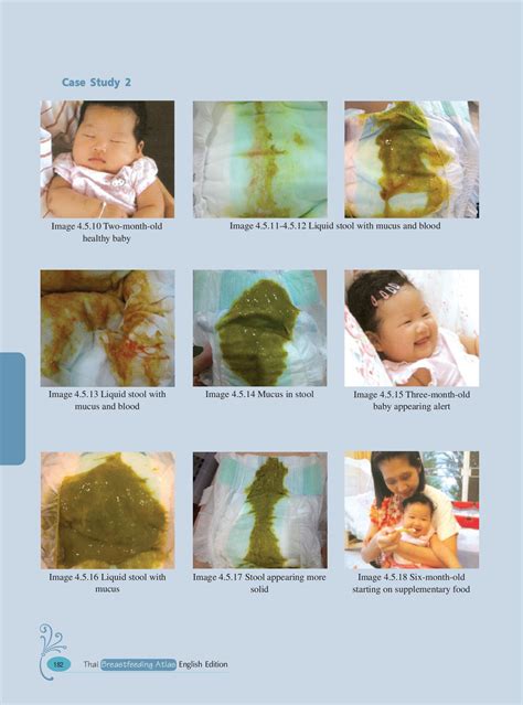 Thai Breastfeeding Atlas English edition - sirapornbellagio - Page 202