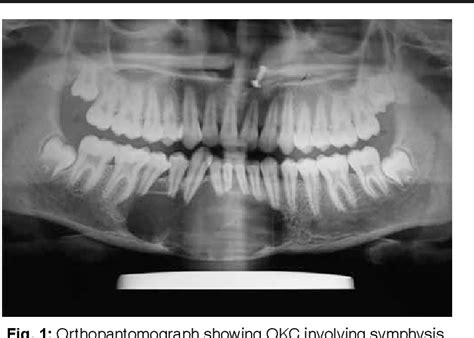 Figure From Treatment Modalities Of Odontogenic Keratocyst Of Maxilla