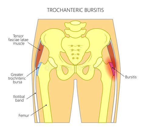 Pain in the Hip Joint_trochanteric Bursitis Stock Vector - Illustration ...