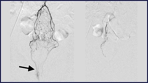 Outcomes Of Hemorrhoidal Artery Embolization From A Multidisciplinary