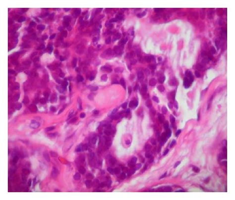 Photomicrograph showing the cribriform pattern of the ACC. | Download ...