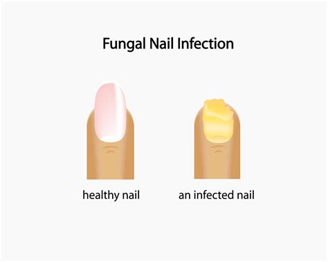 Treatment for Fungal Toenails, Ingrown Nails, Warts, Corns, Calluses