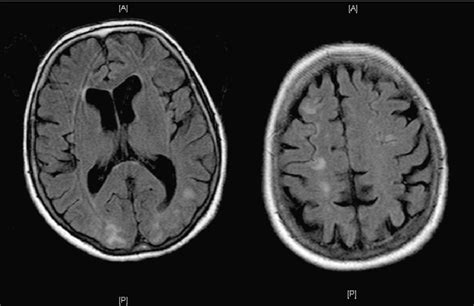 Brain MRI (FLAIR): bilateral posterior hyperintense lesions associated ...