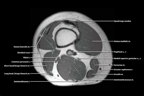 MRI - THIGH