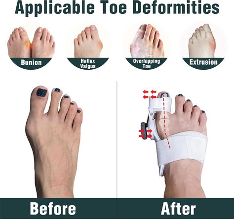 Bunion Corrector Hallux Valgus Corrector With Knob To Adjust The Angle