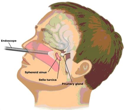 Cirurgia De Hipofise Anatomia Papel E Caneta The Best Porn Website