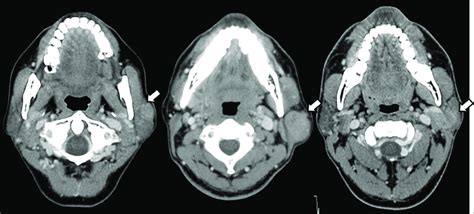 Benign Tumor Parotid Gland