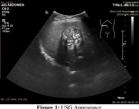 PDF Case Of Mature Cystic Teratoma Of Liver Semantic Scholar